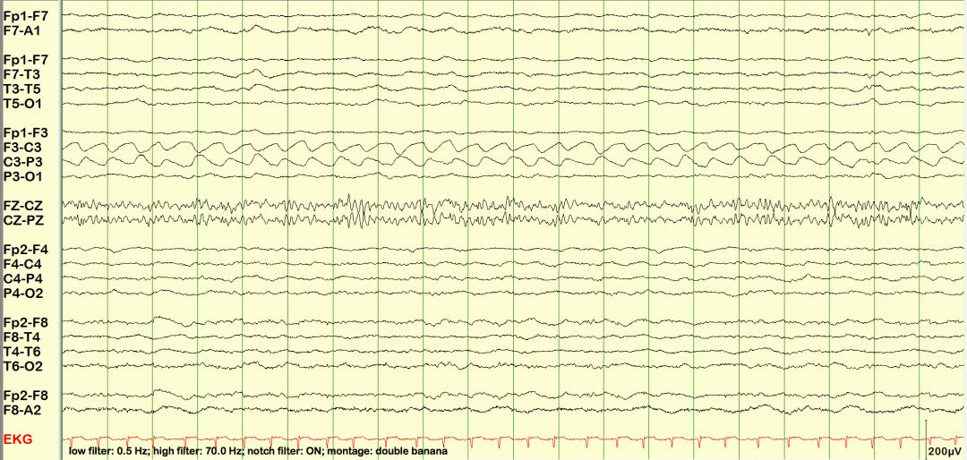 脑电图伪差图,脑电图伪差图谱