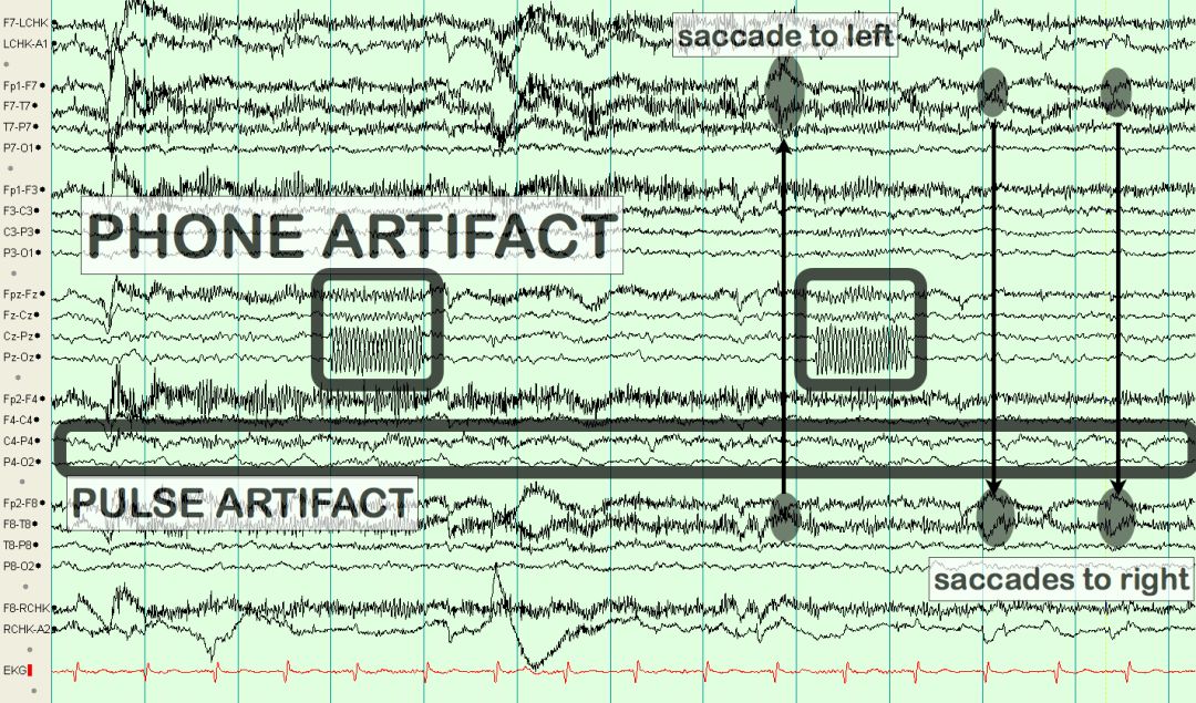 脑电图伪差图,脑电图伪差图谱