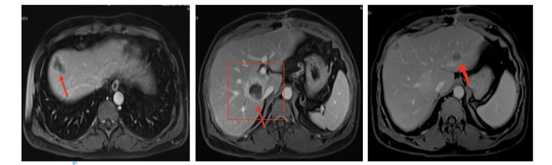 升结肠癌肝转移，如何实现治愈“神话”？|病例分享