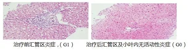 乙肝病毒携带者治疗费用高吗,乙肝携带者需不需要治疗