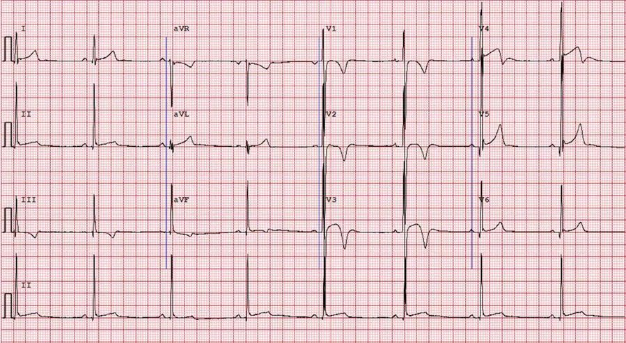 心电图st压低t波倒置严重吗,心电图t波高耸可以治疗吗