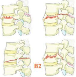 女生二楼摔下脊椎损伤,女孩秋千上摔下断脊椎