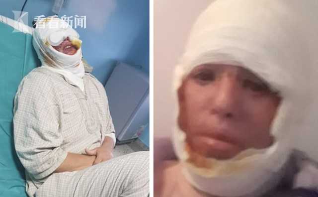 女子熟睡中惨遭毒手,熟睡烧伤女孩后续