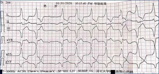 病例丨“一波三折”的三度房室传导阻滞，原因何在？
