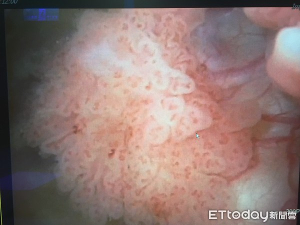 尿出血一点点是什么原因,尿出血了