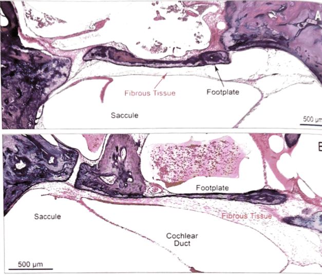 梅尼埃病深度解析,梅尼埃病病理解剖