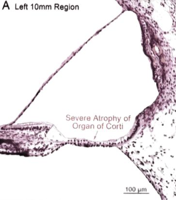 22张图，细说梅尼埃病的组织病理学特点丨“晕”筹帷幄