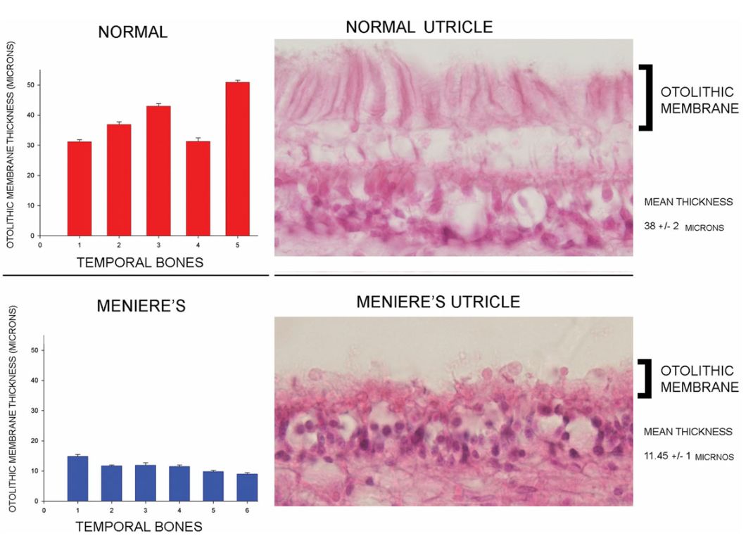 梅尼埃病深度解析,梅尼埃病病理解剖