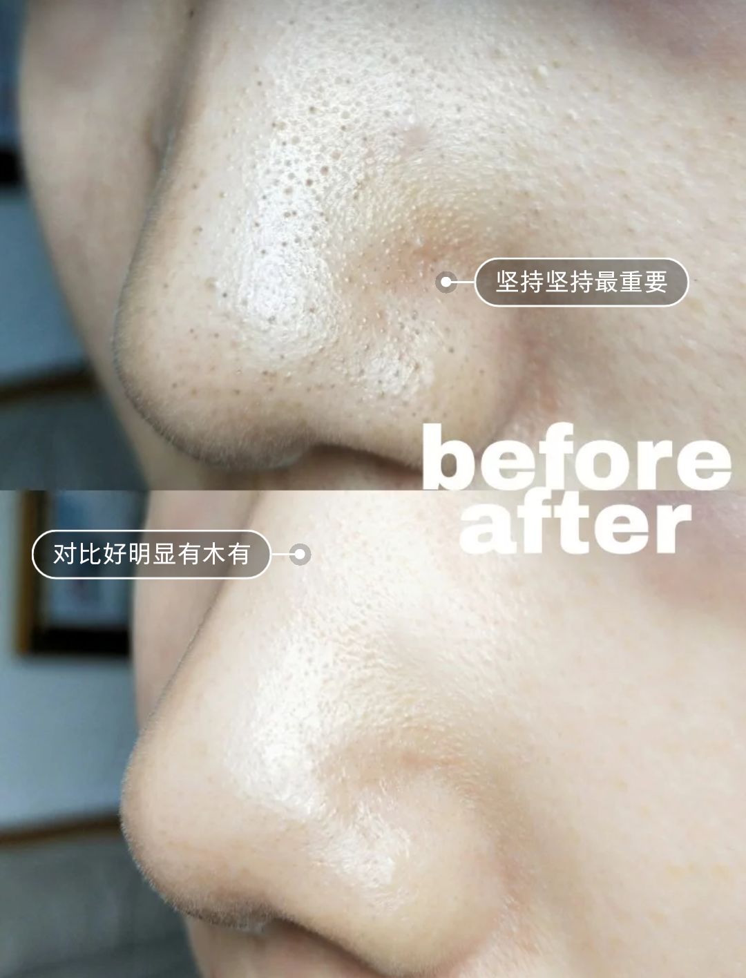 10鍒嗛挓娓呴櫎榛戝ご绮夊埡,榛戝ご绮夊埡鎸ゅ帇娓呯悊姣涘瓟绮楀ぇ