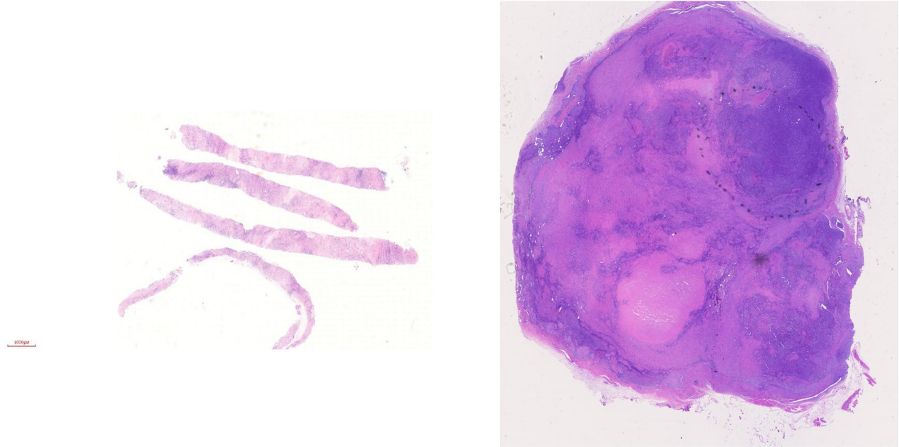 2020年淋巴瘤病理诊断必备知识点,淋巴瘤病理质控