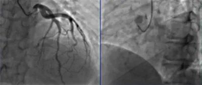 主动脉夹层真假腔鉴别超声示意图,主动脉夹层诊断中国专家共识
