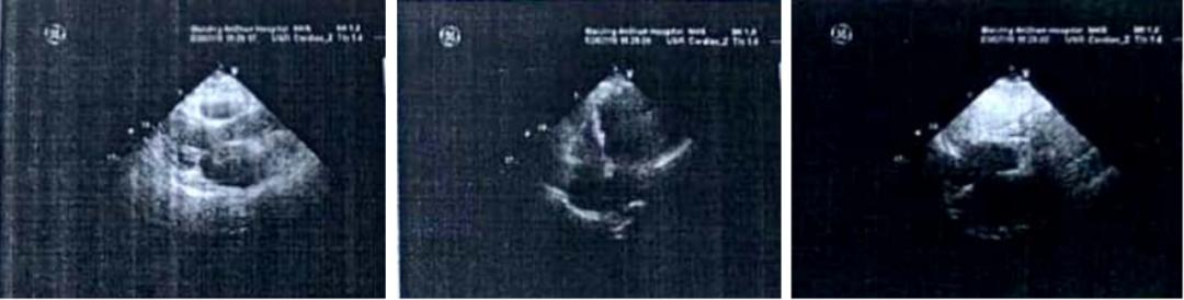 ⼤剂量琥铂酸美托洛尔缓释⽚治疗房颤并⼼衰⼀例