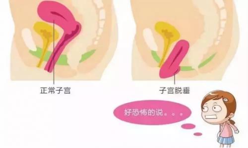 大笑咳嗽会流尿咋办,大笑咳嗽漏尿做什么手术