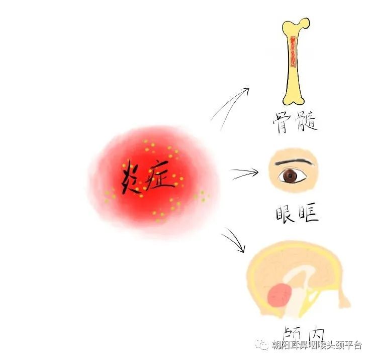 感冒引起鼻窦炎头痛,突然急性鼻窦炎