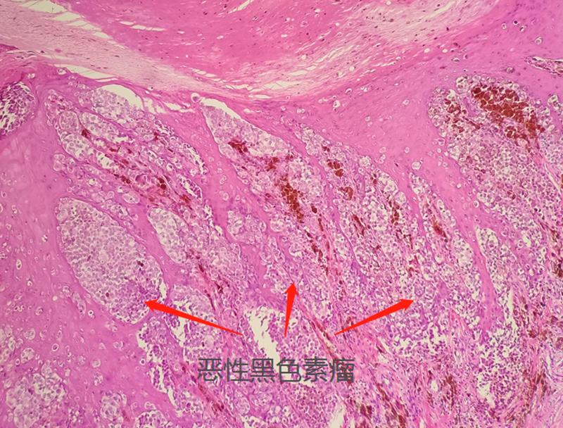 小黑痣在长大怎么回事,小黑痣增多与哪些因素有关