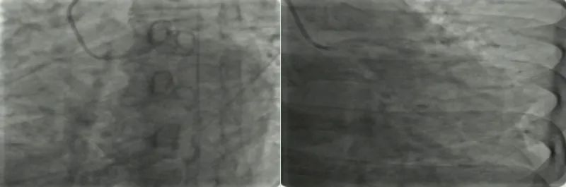 病人突发心肌梗死医生抢救视频,冠心病人抢救