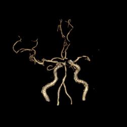 左侧大脑后动脉开窗畸形图片,脑部基底动脉开窗畸形如何治疗