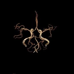 左侧大脑后动脉开窗畸形图片,脑部基底动脉开窗畸形如何治疗