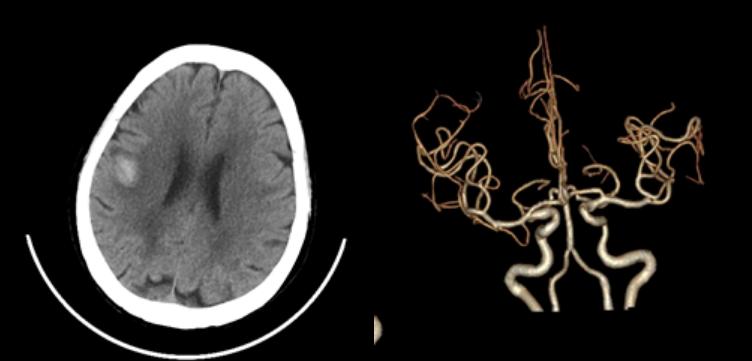 左侧大脑后动脉开窗畸形图片,脑部基底动脉开窗畸形如何治疗