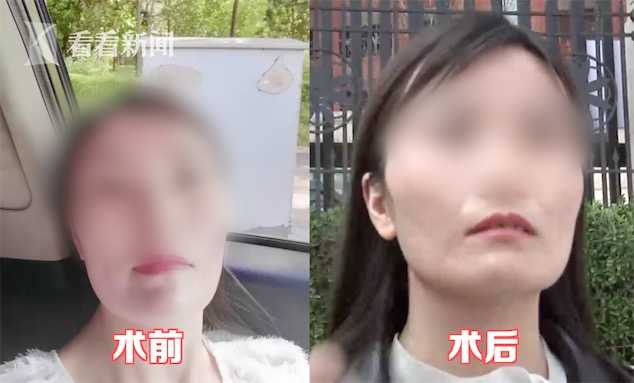 花6万块整容没想到整成这幅模样,脸太瘦整容