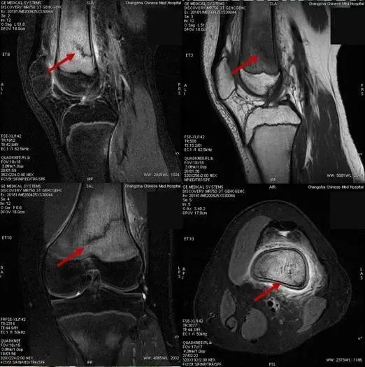 7人骨折算是初三学生吗,初三开学多人骨折