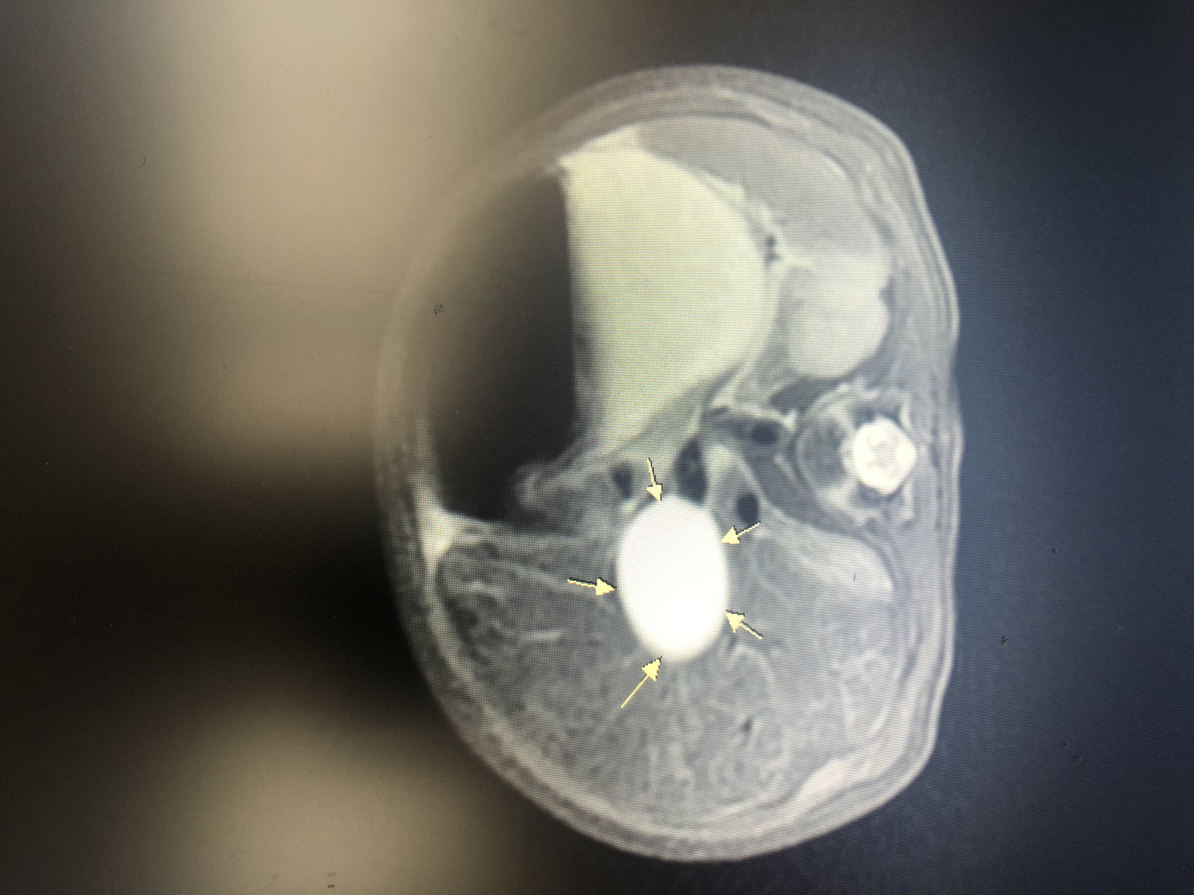 胆总管增大12mm,儿童胆总管多少算扩张