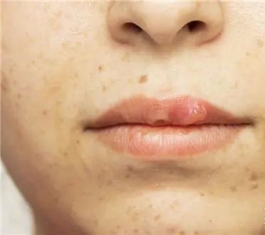 长期补充胶原蛋白的人怎么样了,长期喝胶原蛋白的人最后怎么样了