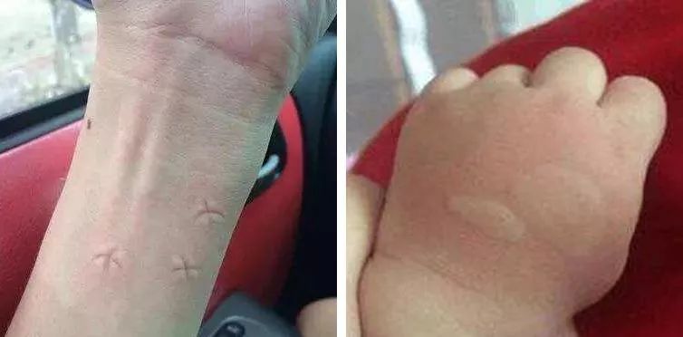 日本防蚊虫药膏,日本蚊子叮咬止痒膏儿童