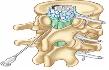 产后腰痛的定义及康复方案,打无痛产后腰痛是怎么回事