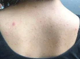 前胸后背都长痘痘全是黑印,背后有痘痘可以穿露背装吗