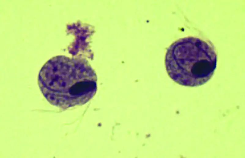 尿液中有肉眼可见杂质正常吗,尿液有形成分检查细菌偏高