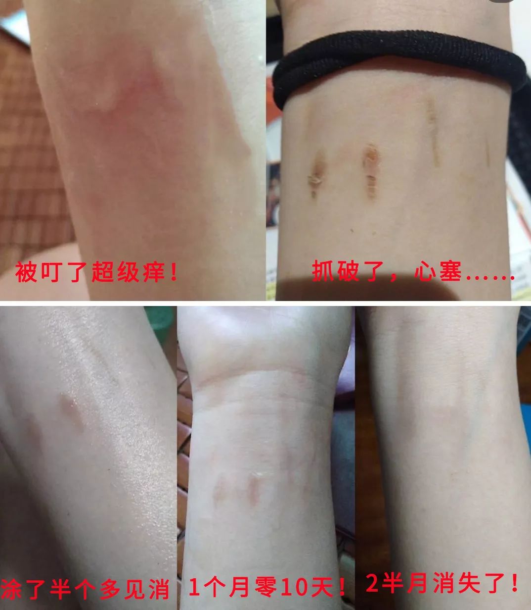 1罐搞定一整夏！20秒止痒消肿，让蚊虫再无嚣张机会