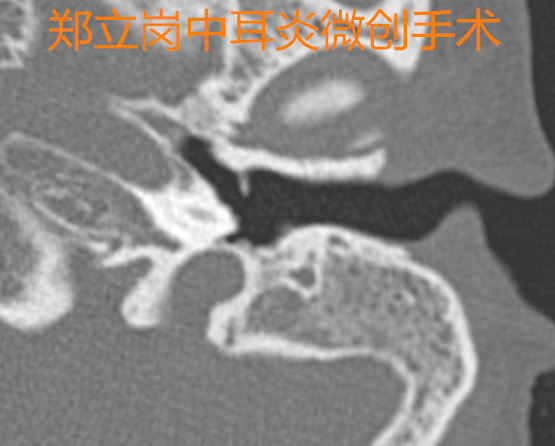 耳朵流脓听力下降需要做手术吗,耳朵流脓不管它会好吗
