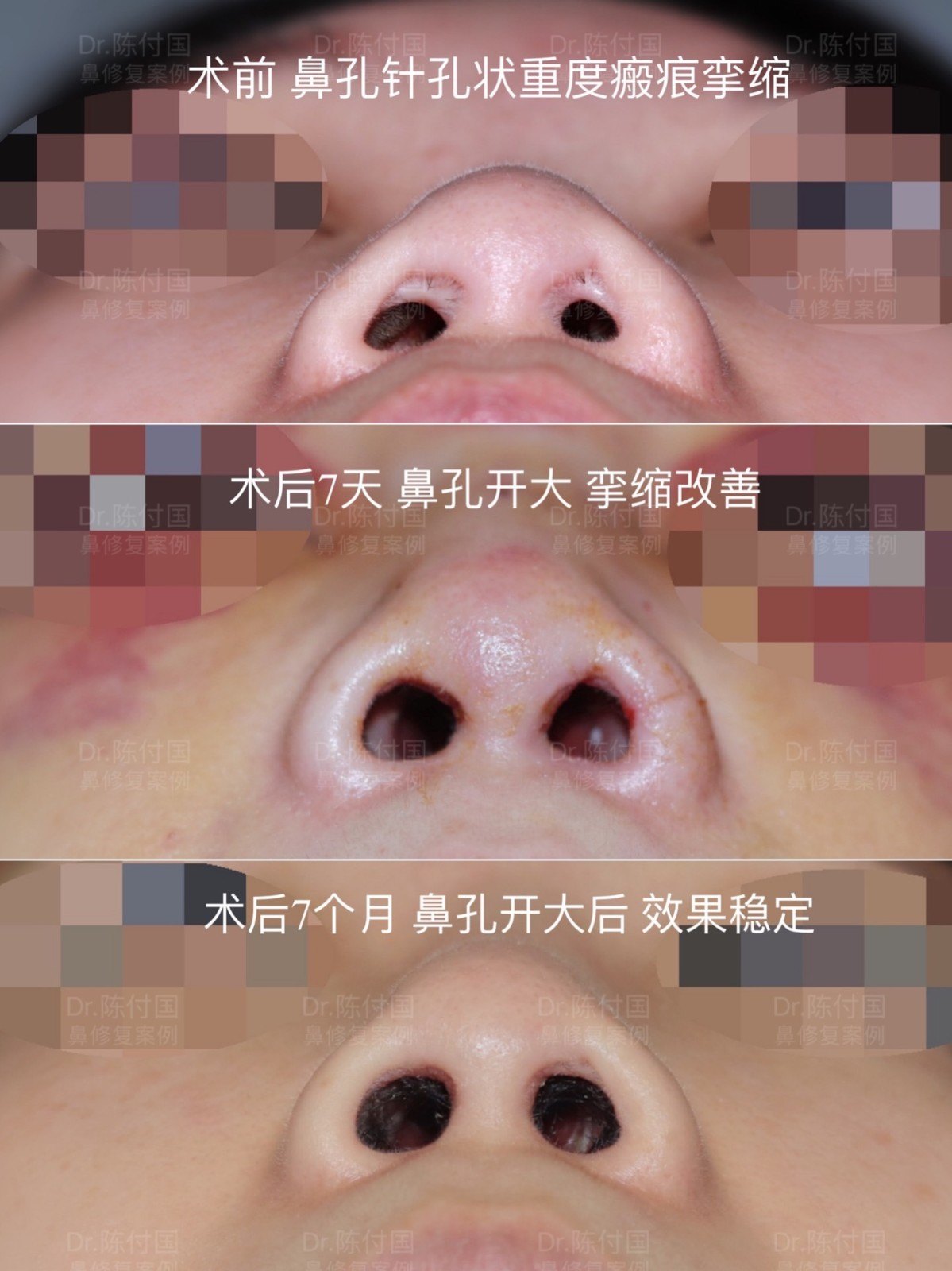 高难度扁鼻子修复,鼻综合手术疤痕修复