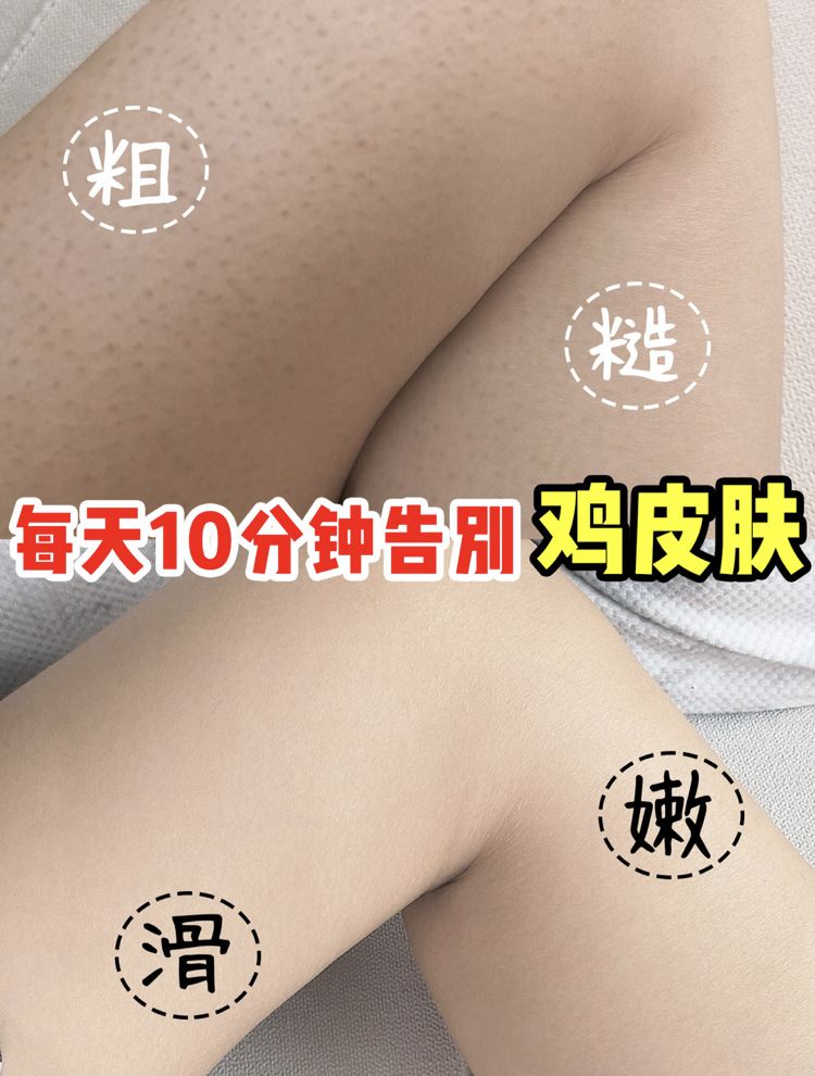 别放弃，烦人的“鸡皮疙瘩”，真的还可以再救一下