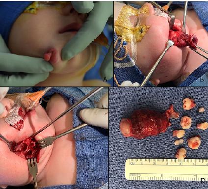 七个月婴儿老张嘴怎么回事,一个婴儿有两张嘴