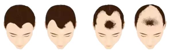 别人脱单我脱发可爱句子,别人脱单自己脱发怎么办