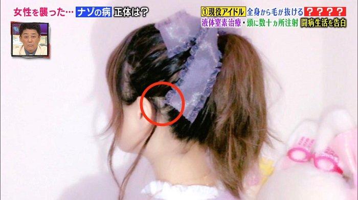 日本16岁美少女偶像歌手脱发到光头！“沦为”假发模特后的她，没有忘记自己甜美的笑容...