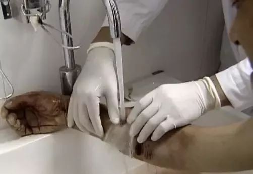 被流浪猫咬到没什么大事吧,不小心被猫咬了一口要打针么