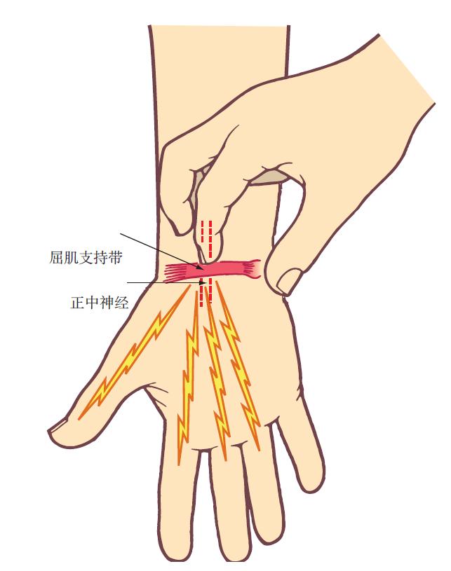 腕管综合征的诊断要点是,腕管综合征诊断标准mr