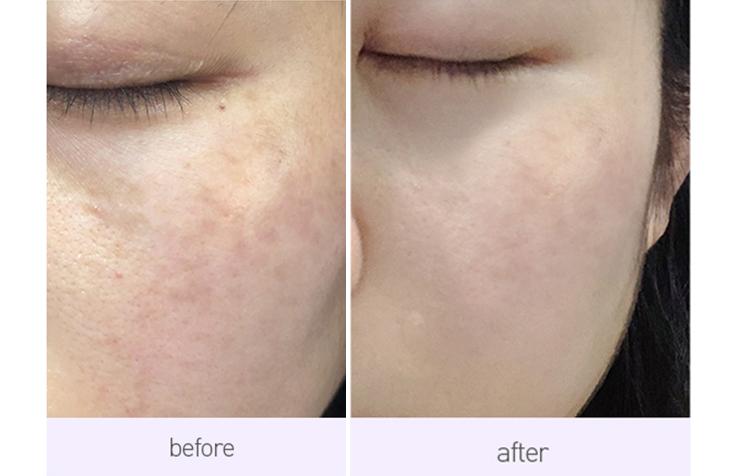 让脸上斑去掉,让脸上的皮肤变白