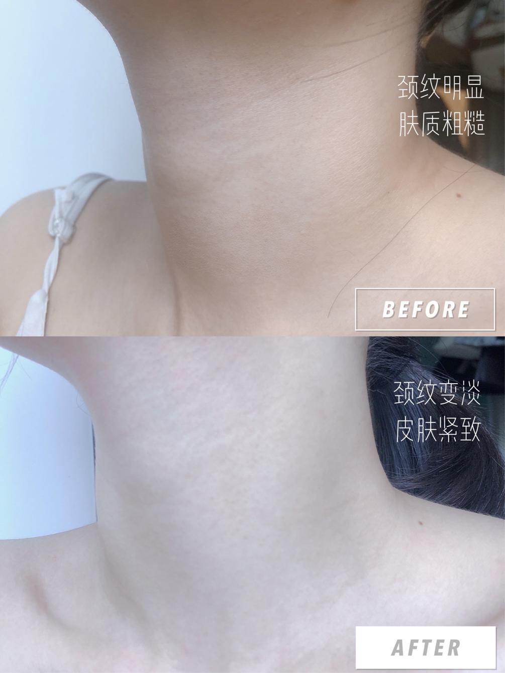 女人脖子有颈纹和年龄有关吗,一条颈纹代表二十岁