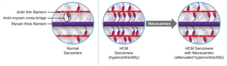 肥厚型心肌病特效新药强势来临：Mavacamten的前世、今生和未来｜安贞心语