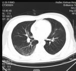 新冠化湿败毒中药方,新冠湿毒