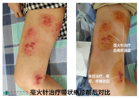 夏天穿两层棉裤还是冷，大爷无奈刺入烧红的钢针，效果竟出乎意料！【针灸宝鉴】