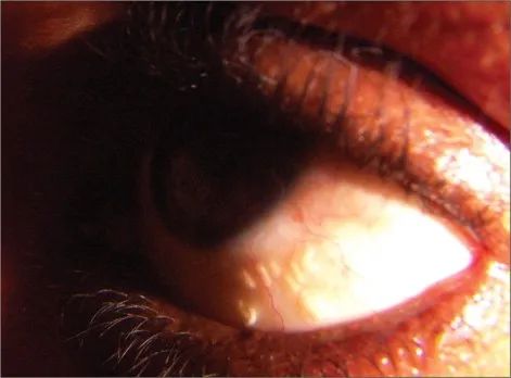 51岁老刘臀部包块不断长大,华山感染专家:是非洲来的“偷渡客”