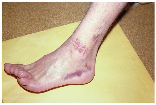 踝关节损伤的处理7条助你应对,踝关节韧带损伤多久能恢复正常