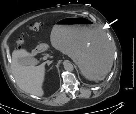 请简述急性腹痛的急诊处理流程,腹痛的急诊诊治思维