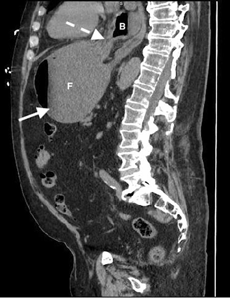 请简述急性腹痛的急诊处理流程,腹痛的急诊诊治思维