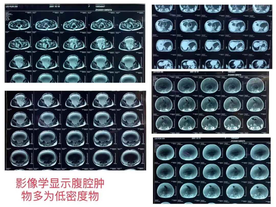 肠话短说|陈功教授病例分享：低级别粘液性肿瘤腹腔“15kg巨型肿物”减瘤术